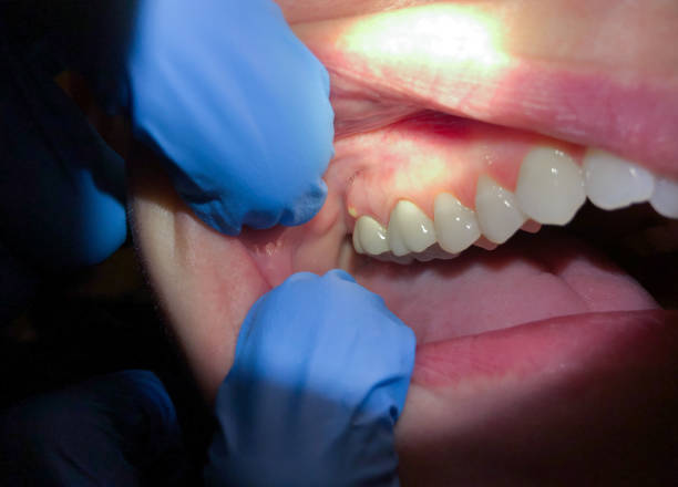 Best Emergency Tooth Extraction in Jamestown, NC